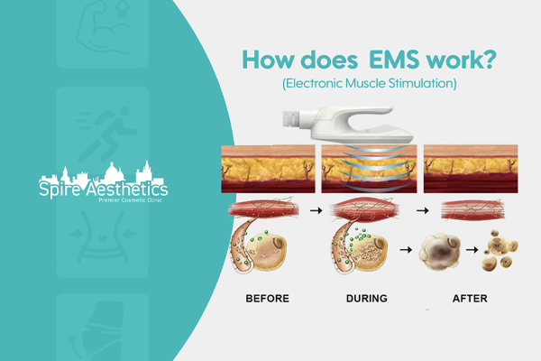 EMS treatment for post pregnancy weight loss treatment Whitley Bay