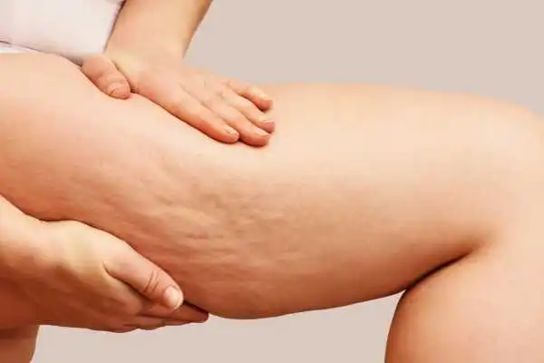 Image of woman showing leg with cellulite Whitley Bay