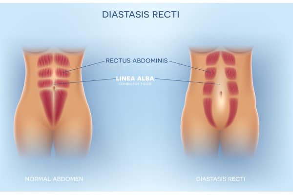What Non-Surgical Options Are Available for Diastasis Recti Whitley Bay?