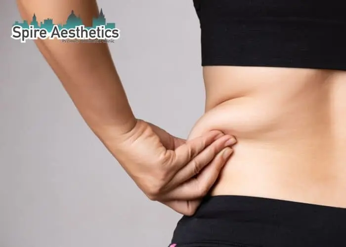 Image of woman pinching fat on their hips Whitley Bay. Fat Freezing treatment