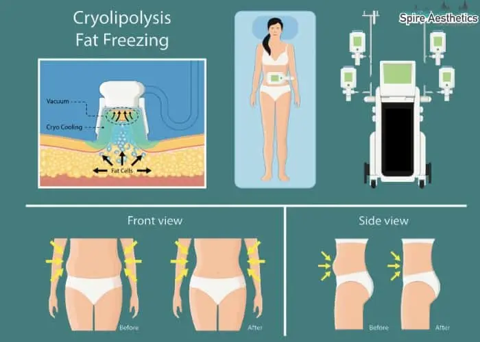 Fat freezing treatment Whitley Bay benefits for competitions to remove stubborn fat deposits.