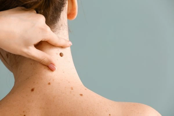 skin blemish removal Whitley Bay treatment
