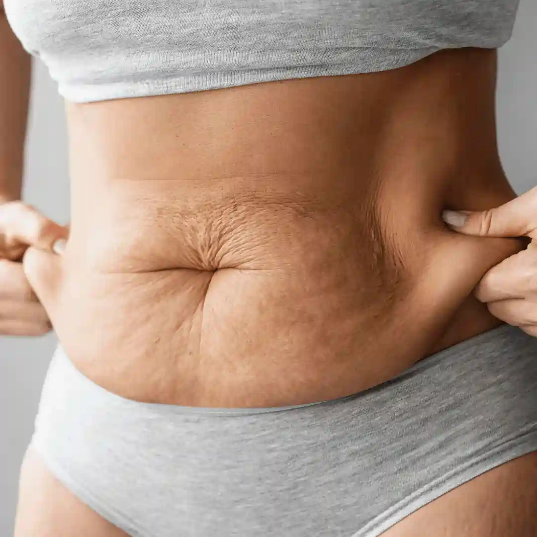 Is It Normal to Have Loose Skin After Pregnancy Whitley Bay?